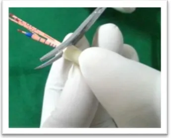 Fig 7 e : Completed obturation  
