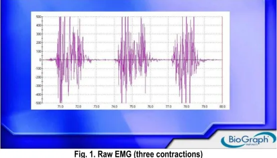 Fig. 1. Raw EMG (three contractions) 