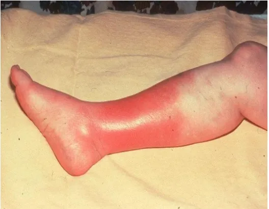 Fig. 11). Cellulitis of bitten limb 