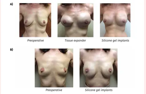 Table 2. Types of breast reconstruction: Alloplastic versus autologous.