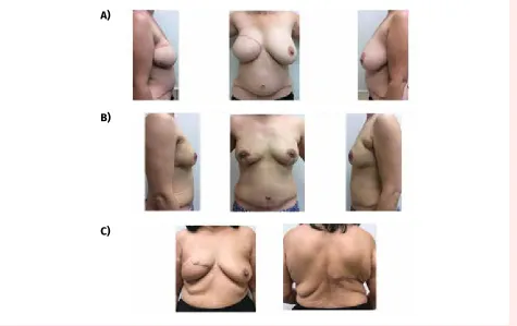 Table 3. Types of alloplastic (implant-based) reconstruction