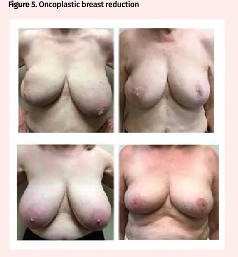 Figure 4. Fat grafting for lumpectomy defect reconstruction