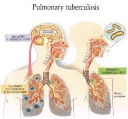 Figure 1 : Types of tuberculosis 