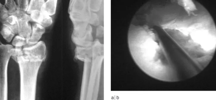 Fig. 6 a-b. Arthroscopic assisted fixation: a. A displaced intraarticular fracture; b
