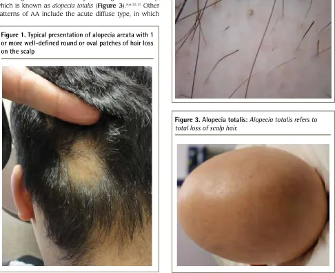Figure 1. Typical presentation of alopecia areata with 1 or more well-defned round or oval patches of hair loss on the scalp