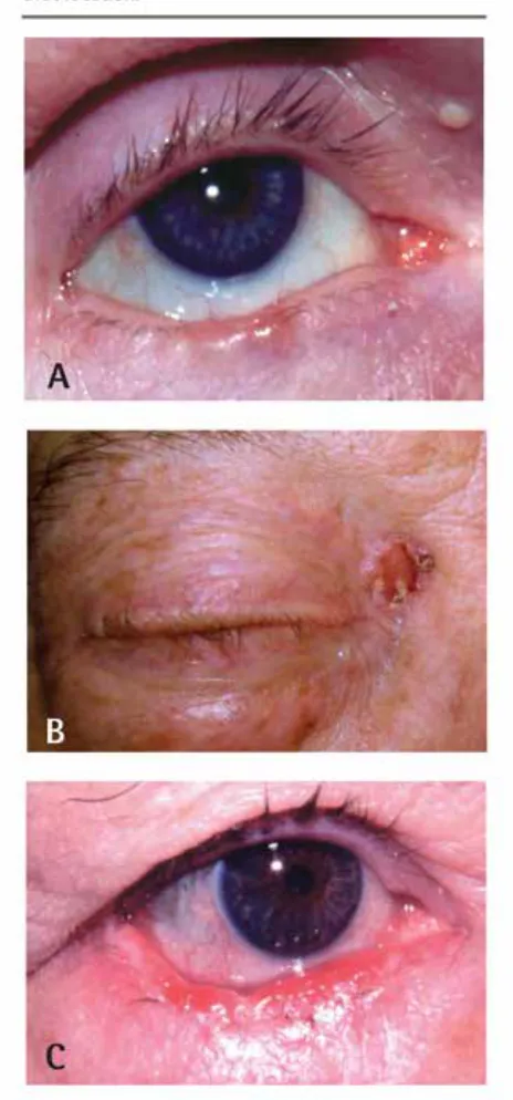 table 2. Sensitivity and specificity of LuI (loss of eyelashes, ulceration, and infiltration) triage key features alone or in combination in identifying malignant eyelid lesions