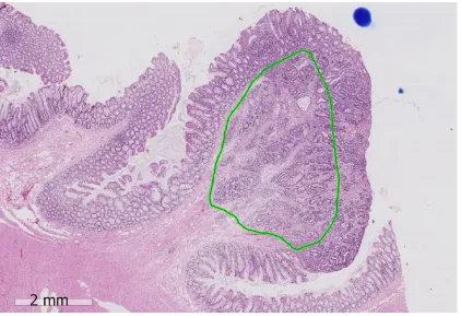 Figure 1Figure 1  An example showing measurement of the area of submucosal invasion on a digital slide of a pT1