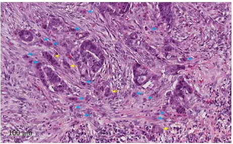 Figure 2Figure 2  An example of tumour budding (blue arrows) and poorly differentiated clusters (yellow arrows) at