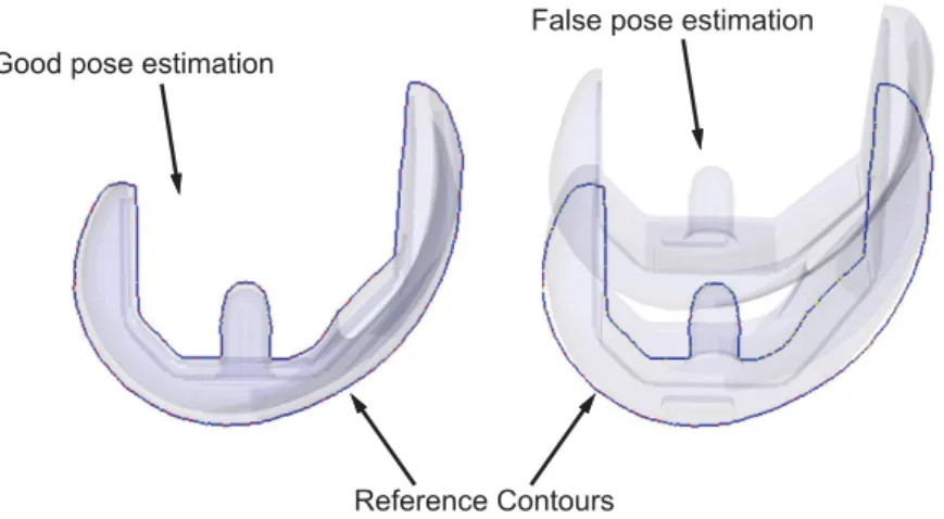 Figure 2.3: False pose estimation due to convexities: the alignment of only one condyle create a local minimum in the cost function.