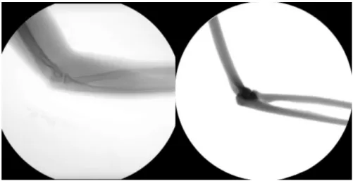 Figure 2.5: Comparison between real elbow fluoroscopic image (left panel) and the relevant Digitally Reconstructed Radiography (DRR) (right panel).