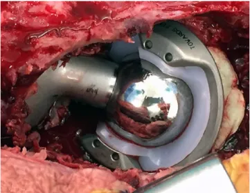 Fig. 1  An example of a constrained system using an external  metal ring locked to the liner in order to avoid mechanical  re-expansion of the liner once the head is within the socket.