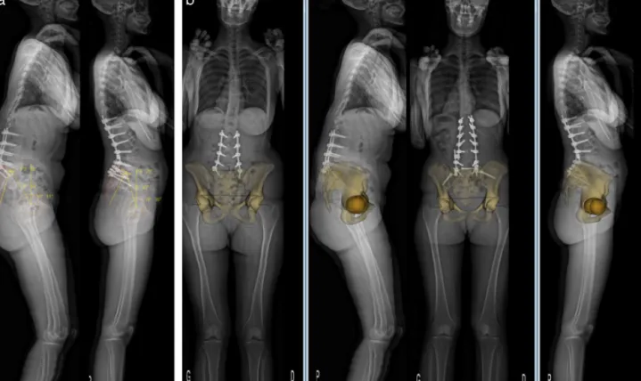 Fig. 1. a: pelvic parameters before and after transpedicular osteotomy. PI: pelvic incidence ( ◦ ); PT: pelvic tilt ( ◦ ); SS: sacral slope ( ◦ ); b: 3D reconstruction.
