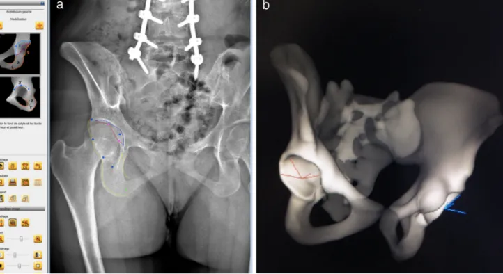 Fig. 2. a: acquisition of the acetabular parameters; b: 3D measurement of acetabular anteversion and acetabular inclination.