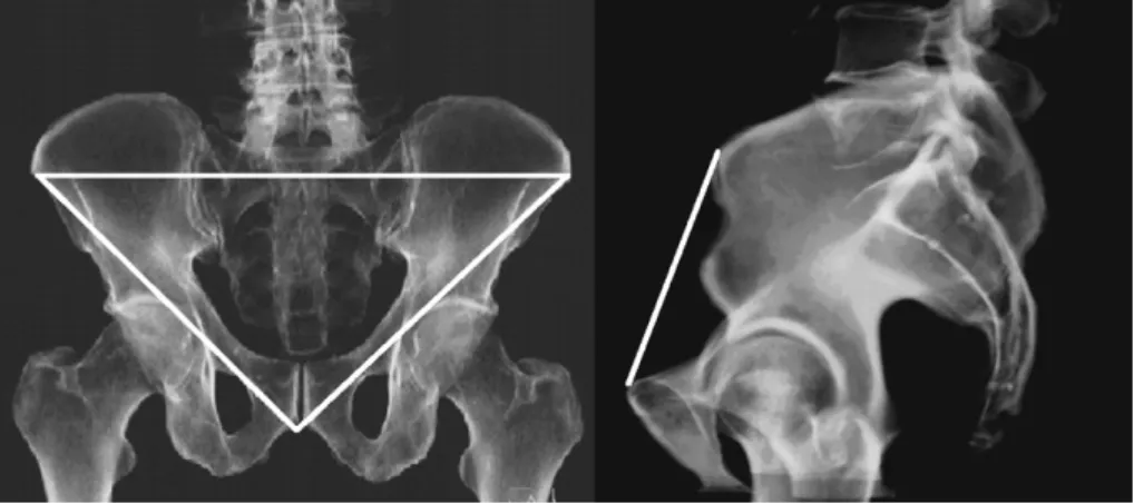 Figure 2 Angle of pelvic tilt (alpha angle) is deﬁned as the angle between the anterior pelvic plane and the vertical plane.