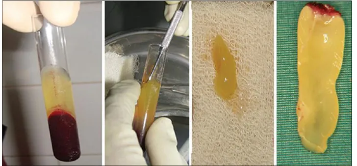 Figure 1: Preparation of PRF 