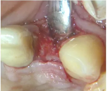 Figure 2: Elevation of the Flap            Figure 3: Implant placement done  