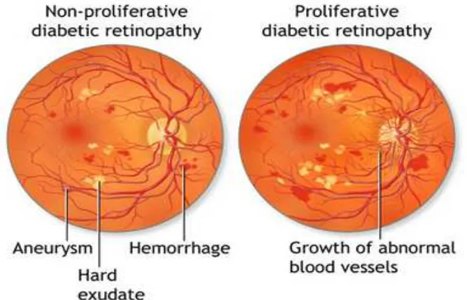 Fig 4: Diabetic retinopathy leading to scattered haemorrhages,  