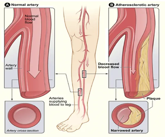 Figure 3 Site of peripheral arterial disease (Nucleus Communications, 2003)  
