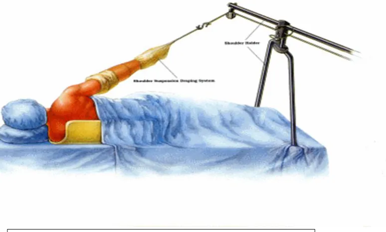 Figure 7: Patient in lateral decubitus position for shoulder surgery