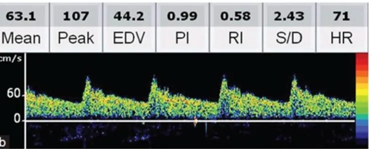 Figure 10:  Transcranial Doppler waveform