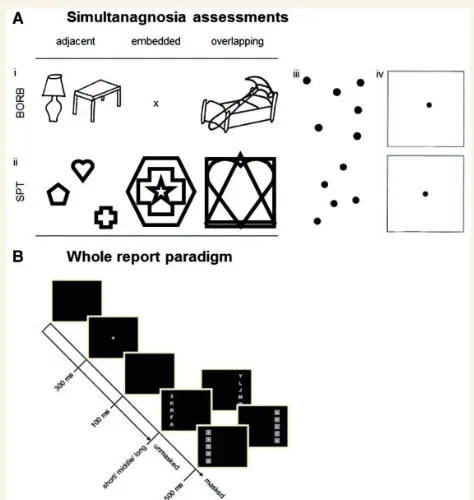 Figure 1 Schematic illustration of the simultanagnosiaStimuli of the overlapping-ﬁgures test of the BORB for each pres-entation conditions (adjacent and overlapping); (tests and the TVA-based whole report paradigm