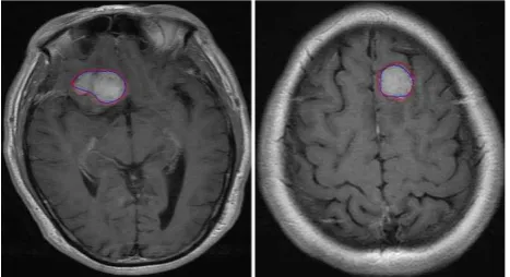Figure 14. Segmentation of the brain tumour performed by the proposed algorithm (blue) and manual delineation (red) 
