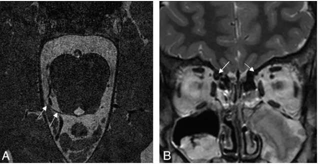 Fig 2. CNVI aplasia in a 3-year-old boy. A, Conventional resolution 3D-bTFE image at the level of the pontomedullary junction shows a normal right CNVI (arrow), but the left CNVI is absent.B, In a coronal T2-weighted image of the orbit, hypoplastic change is not observed in the left lateral rectus (arrow).
