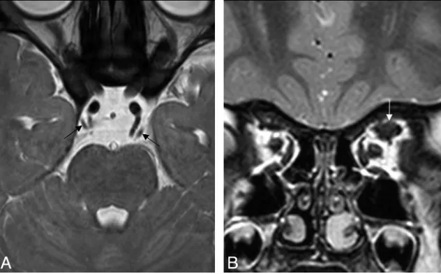 Fig 5. Superior rectus hypertrophy in a 3-year-old boy.T2-weighted image of the orbit shows a hypertrophic left superior rectus ( A, Conventional-resolution 3D-bTFE image at the level of the upper pons shows a normal-size CNIII, bilaterally (arrows)