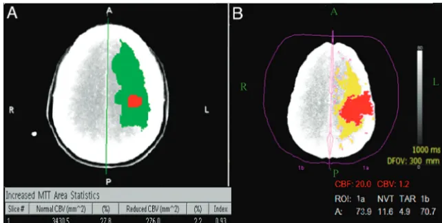 Fig 2. CTP analysis results of a 40-year-old woman with infarct in the left hemisphere