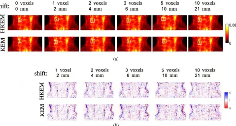 Fig. 12.Mean activity concentration comparison between reconstructedpatient image with KEM using only MR and HKEM and OSEM on 30-sacquisition