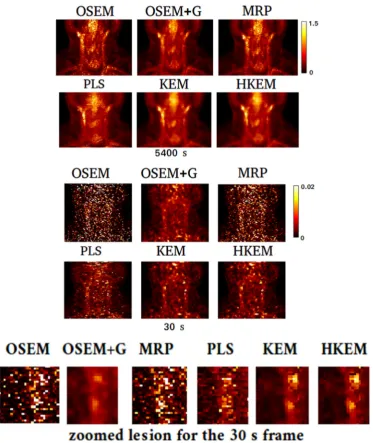 Figure 9. [figure reports in the top line the 5400 s acquisition, in the middle the 30 s frame and in 18F]FDG study reconstructed images, at the 3rd iteration with OSEM, OSEM+G, MRP, PLS, KEM using only MR and the proposed method HKEM
