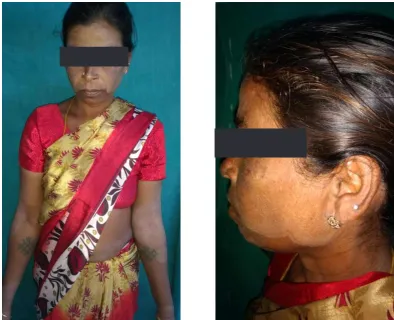 Fig. 6a and  6b  Extensive Dermatophytosis