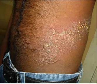 Fig. 12 Herpes zoster ophthalmicus