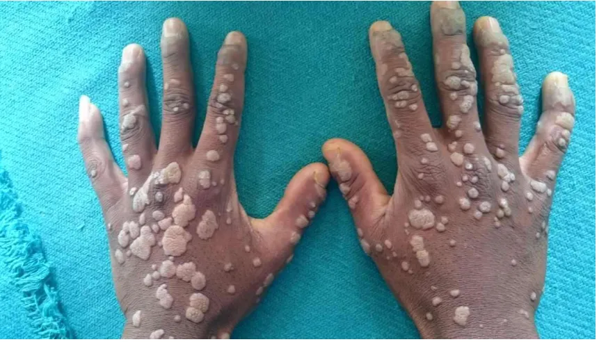 Fig. 14 Extensive genital wart