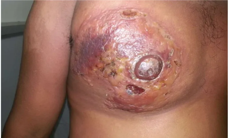 Fig. 22 Secondary syphilis – Lichenoid lesions over palms