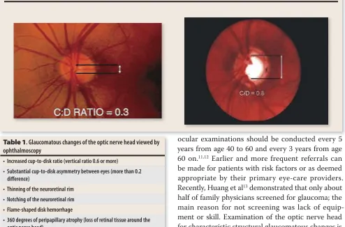 Table 1. Glaucomatous changes of the optic nerve head viewed by 