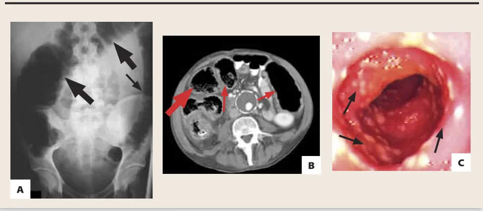 Figure 1. Features of C diﬃ  cile colitis: A) Plain ﬁ lm of abdomen showing bowel wall thickening, loss of haustral markings (thin arrow) and dilation of the ascending and transverse colon (thick arrow); B) Computed tomographic scan of abdomen showing colonic dilation (thin arrows) and bowel wall thickening with stranding (thick arrow); C) Endoscopic view of classic C diﬃ  cile–associated pseudomembranous colitis (arrows mark pseudomembranes).