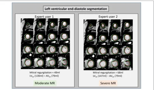 TABLE 2 | The strengths and weaknesses of various non-invasive imagingmodalities in the clinical assessment of the mitral valve and MR.