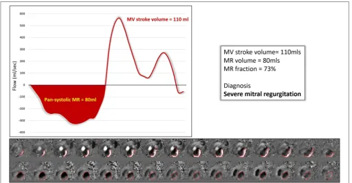 FIGURE 4 | Direct quantiﬁcation of an eccentric MR jet using 4D ﬂow MRI data. The mitral valve stroke volume in this case was 110 mls and the regurgitation 80 mls.The MR fraction was therefore 73% and the net forward ﬂow 5 mls.