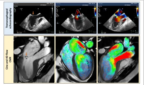 FIGURE 5 | Complementary clinically relevant details can be assessed by using echocardiography; transesophageal echocardiography in this case (blue panel) andCMR with 4D ﬂow streamline visualization