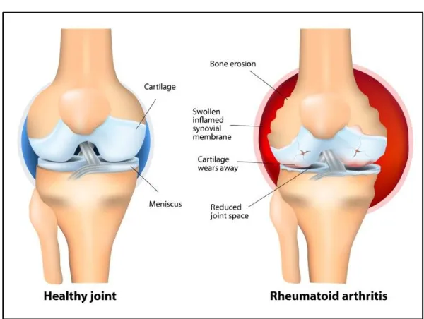 Fig.1 :   Normal and Arthritic Joints 