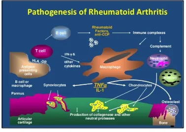Fig.2 : Pathophysiology of Rheumatoid Arthritis 