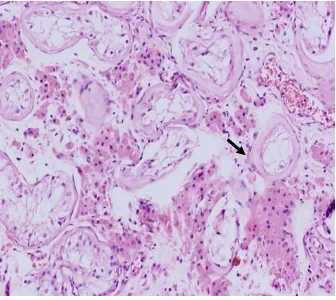 Fig. 17:  Leydig cell hyperplasia(black arrow) with peritubular fibrosis(red arrow), 