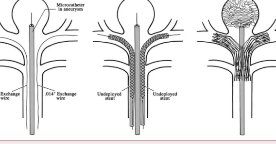 FIGURE 2. Y configuration. The microcatheter and undeployed stents are positioned. After the coils are deposited into the aneurysm, the stents are deployed consecutively to maximize apposition to the vessel lumen and to one another.