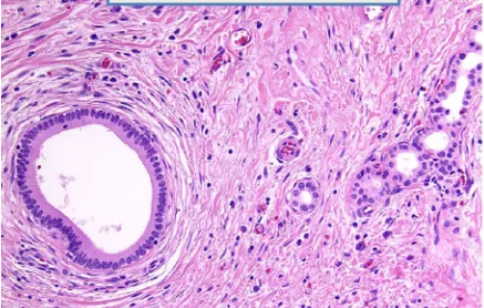 FIG 5– Luschka ductules seen in perimuscular layer at the hepatic surface of 