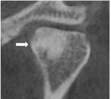 FIGURE 6 : CBCT REVEALING CONDYLAR SCLEROSIS  