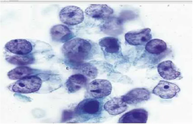 Fig 12 : BAL cytology  smear: squamous cell carcinoma. Picture