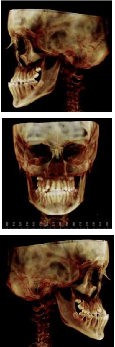 FIGURE 1: CBCT IMAGE OF A HIGH ANGLE CLASS III SUBJECT WITH REVERSE OVERJET 
