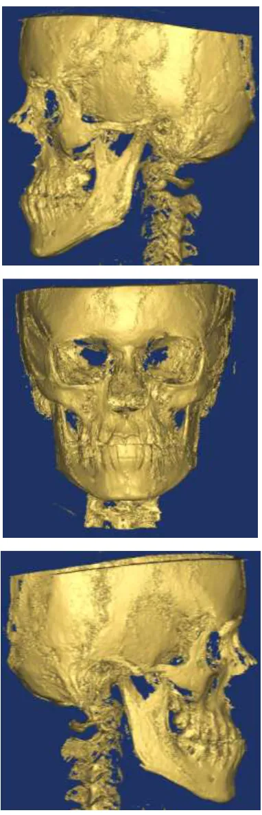 FIGURE 2: 3D IMAGE OF A HIGH ANGLE CLASS III SUBJECT WITH REVERSE OVERJET 