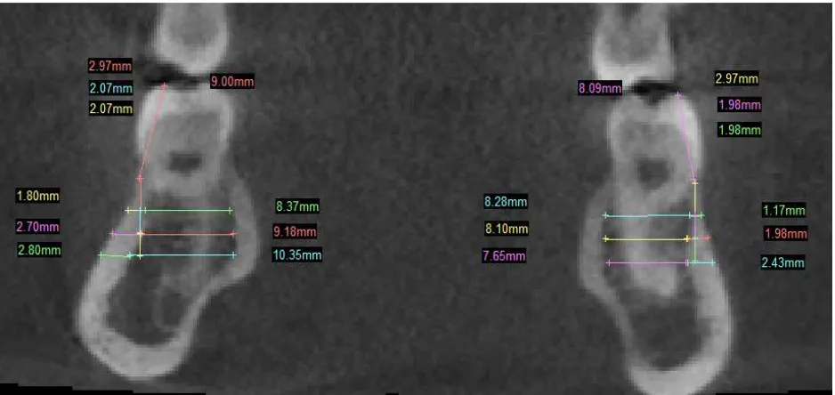 FIGURE 7: MIDDLE OF MANDIBULAR FIRST MOLAR 